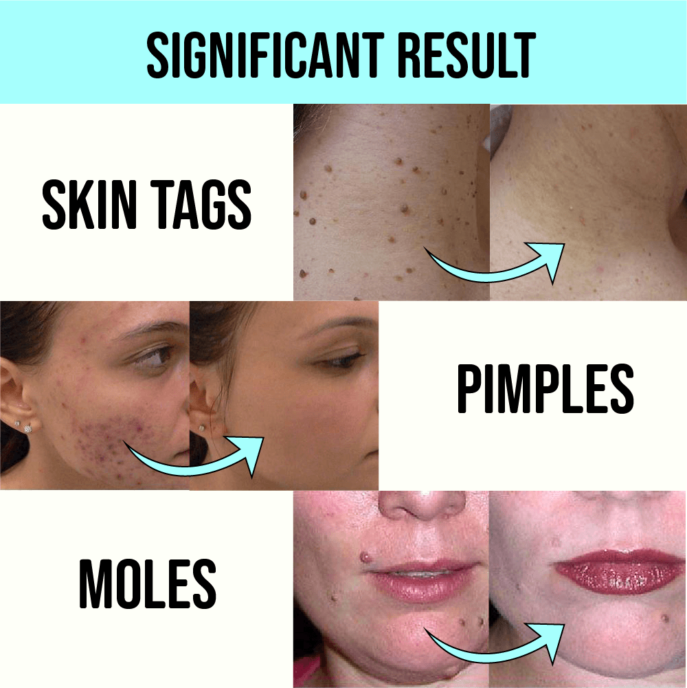 MEDICO™ Blue Light Skin Spot Remover