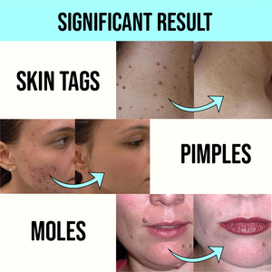 MEDICO™ Blue Light Skin Spot Remover