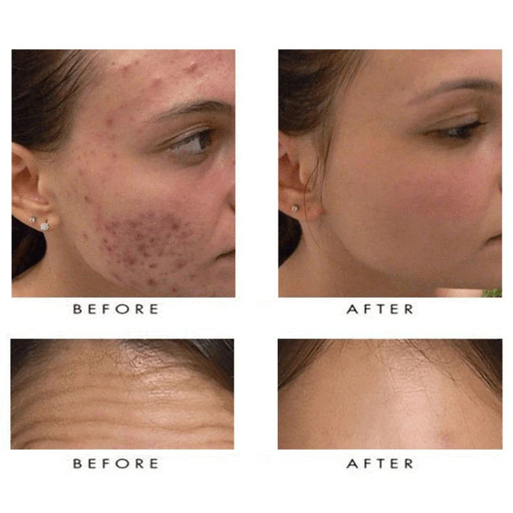 MEDICO™ Blue Light Skin Spot Remover